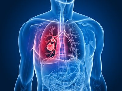 Hallazgo incidental de neoplasia primaria de pulmón: blastoma pulmonar en mujer adulta. Reporte de caso