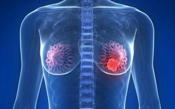 Resultados positivos de trastuzumab deruxtecan en cáncer de mama metastásico HER2-low RH+
