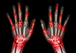 Abatacept: ¿Un medicamento para prevenir la artritis reumatoide?