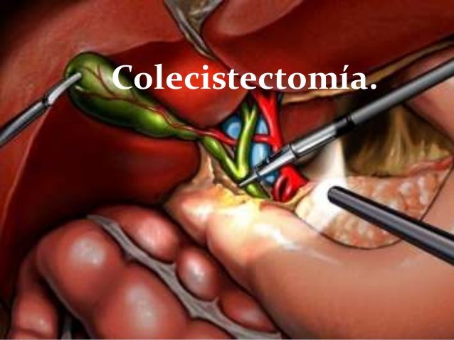 Analgesia postoperatoria con nebulización intraperitoneal de ropivacaína en colecistectomía laparoscópica. Reporte de un caso y revisión de la literatura 