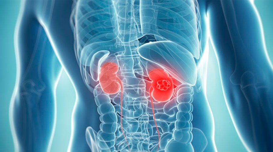 Tumor papilar renal de células claras bifocal no asociado a enfermedad renal terminal