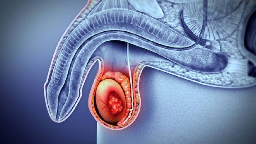 Características de pacientes con tumor germinal testicular tipo seminoma y masa retroperitoneal posquimioterapia