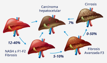 Enfermedad del hígado graso asociada a disfunción metabólica 