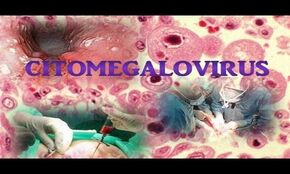 Vínculos entre el citomegalovirus y la hepatitis