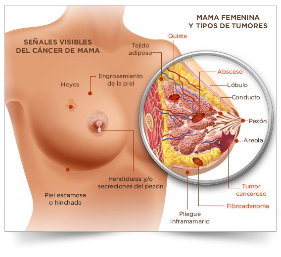 Cáncer de mama invasivo: la mortalidad por cáncer de mama aumenta a largo plazo después del CDIS
