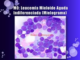 Leucemia mieloide aguda / síndrome mielodisplásico familiar asociada a CEBPA