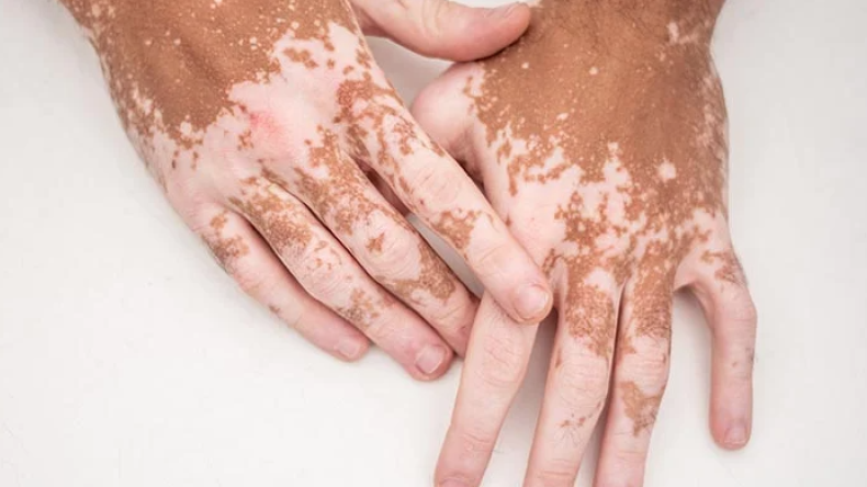 El vitiligo y su patogenia autoinmune multifactorial: de cara al presente y futuro