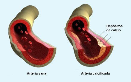 Lipoproteína (a) y Carga Sistémica de Calcificación Arterial