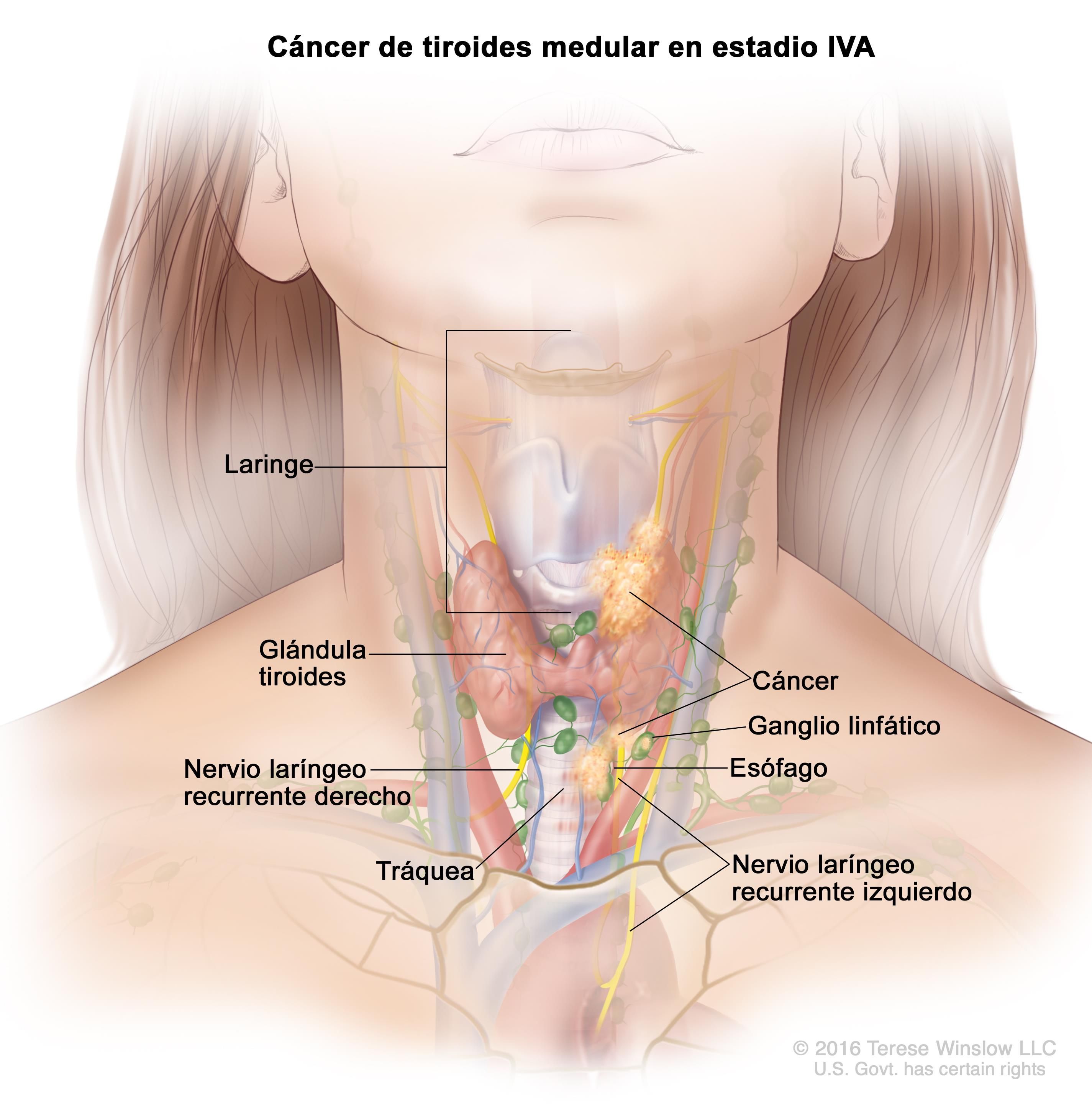 Carcinoma de tiroides en personas mayores: caracterización mediante herramientas de big data