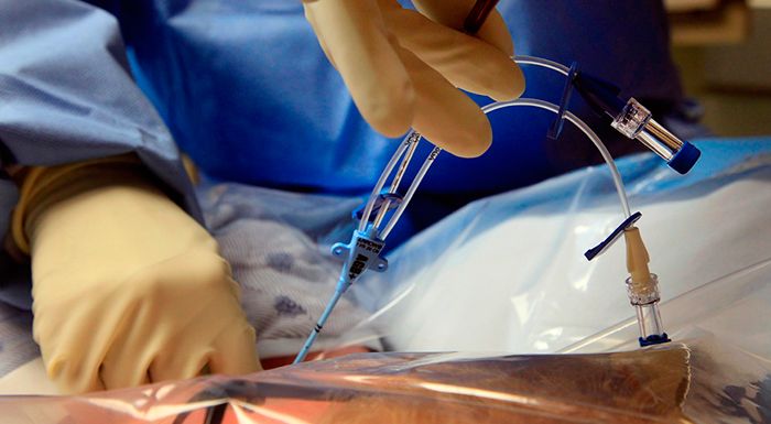 La cirugía es superior al tratamiento endovascular en la ICAE con vena safena adecuada