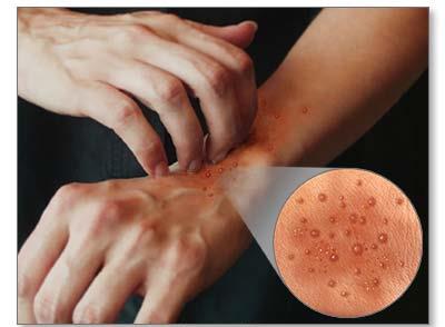 Hasta el 73% de los pacientes con dermatitis atópica tratados con lebrikizumab logran un aclaramiento de la piel de la cara o las manos