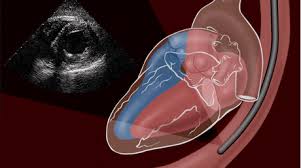 Síndrome de cimitarra, valoración con ecocardiografía transesofágica intraoperatoria. Informe de caso