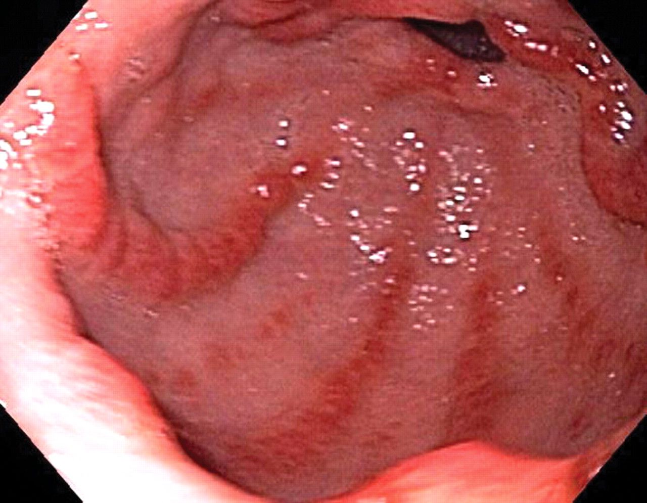 Hemorragia digestiva alta (estómago de sandía) en paciente con esclerodermia limitada (síndrome de CREST)
