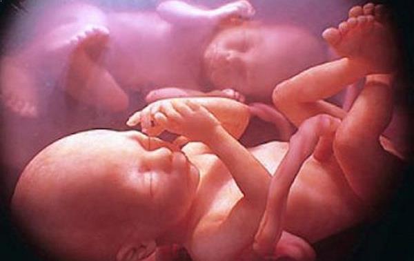 Embarazo gemelar con mola hidatiforme completa y feto vivo coexistente