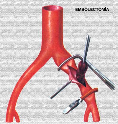 Embolectomía pulmonar quirúrgica en el manejo del tromboembolismo pulmonar agudo: reporte de caso