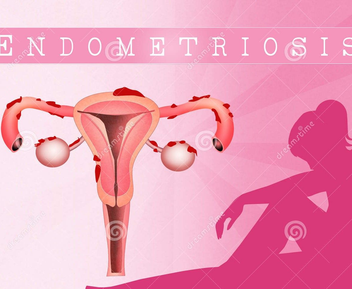 En endometriosis la prueba de saliva conllevaría menos cirugías
