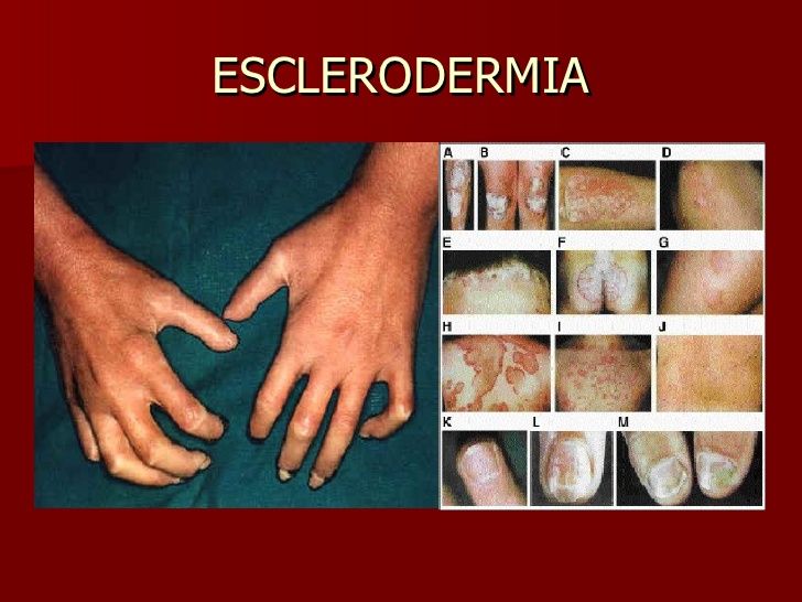 Día Europeo de la Esclerodermia: síntomas, diagnóstico y tratamiento