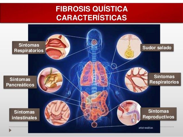 Fibrosis quística como enfermedad en la adultez