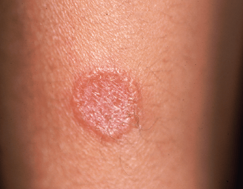 Granuloma anular: un reto dermatológico