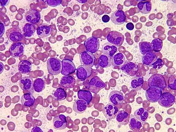 Recomendaciones de las subcomisiones de la SAH para pacientes hematológicos en la pandemia SARS-COV-2: Leucemia mieloide crónica (LMC). Subcomisión de LMC-SAH