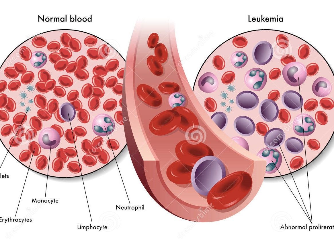 Reporte de casos: leucemia/linfoma de células T del adulto asociada al virus HTLV-1