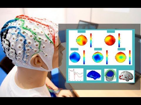 Estimulación cerebral profunda para mapear objetivos terapéuticos para cuatro trastornos cerebrales