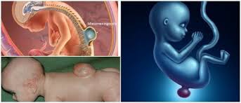 Protocolo de anestesia para cirugía de cierre abierto de mielomeningocele in-utero: una serie de casos