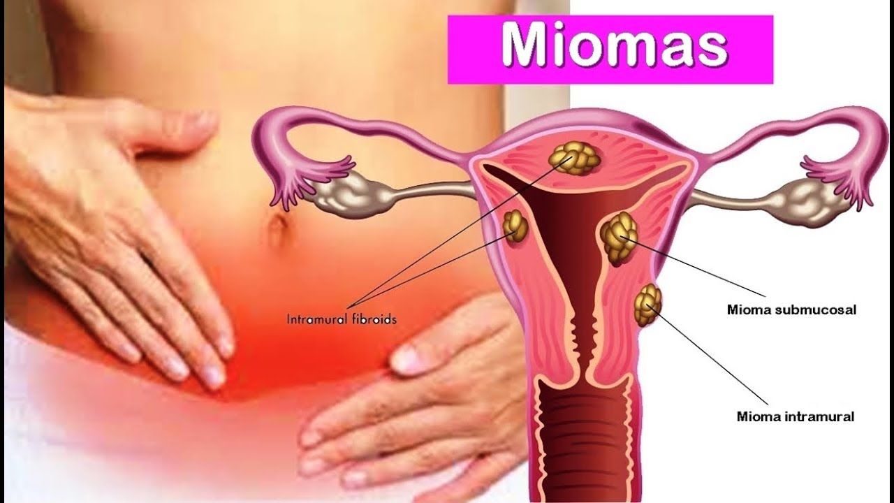 Tratamiento no invasivo para fibromas uterinos es más seguro y tan efectivo como la cirugía