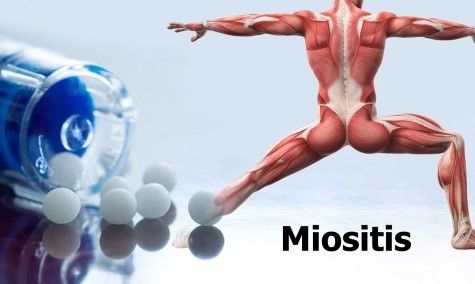 Miositis inducida por ácido trans-retinoico