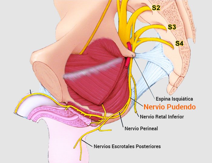 Anestesia regional guiada por ultrasonido en territorio del nervio pudendo