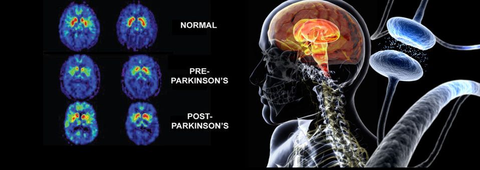 Dolor en la enfermedad de Parkinson. Una mirada a un aspecto poco conocido de esta patología.