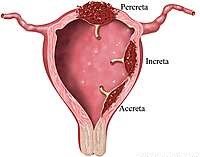 Acretismo placentario: Un diagnóstico emergente. Abordaje quirúrgico no conservador.