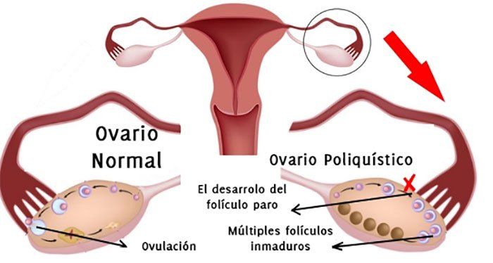 Metformina en el tratamiento del síndrome de ovarios poliquísticos. Un ensayo clínico aleatorizado.