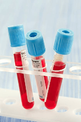 Una prueba de sangre puede detectar el cáncer de pulmón en estadio temprano